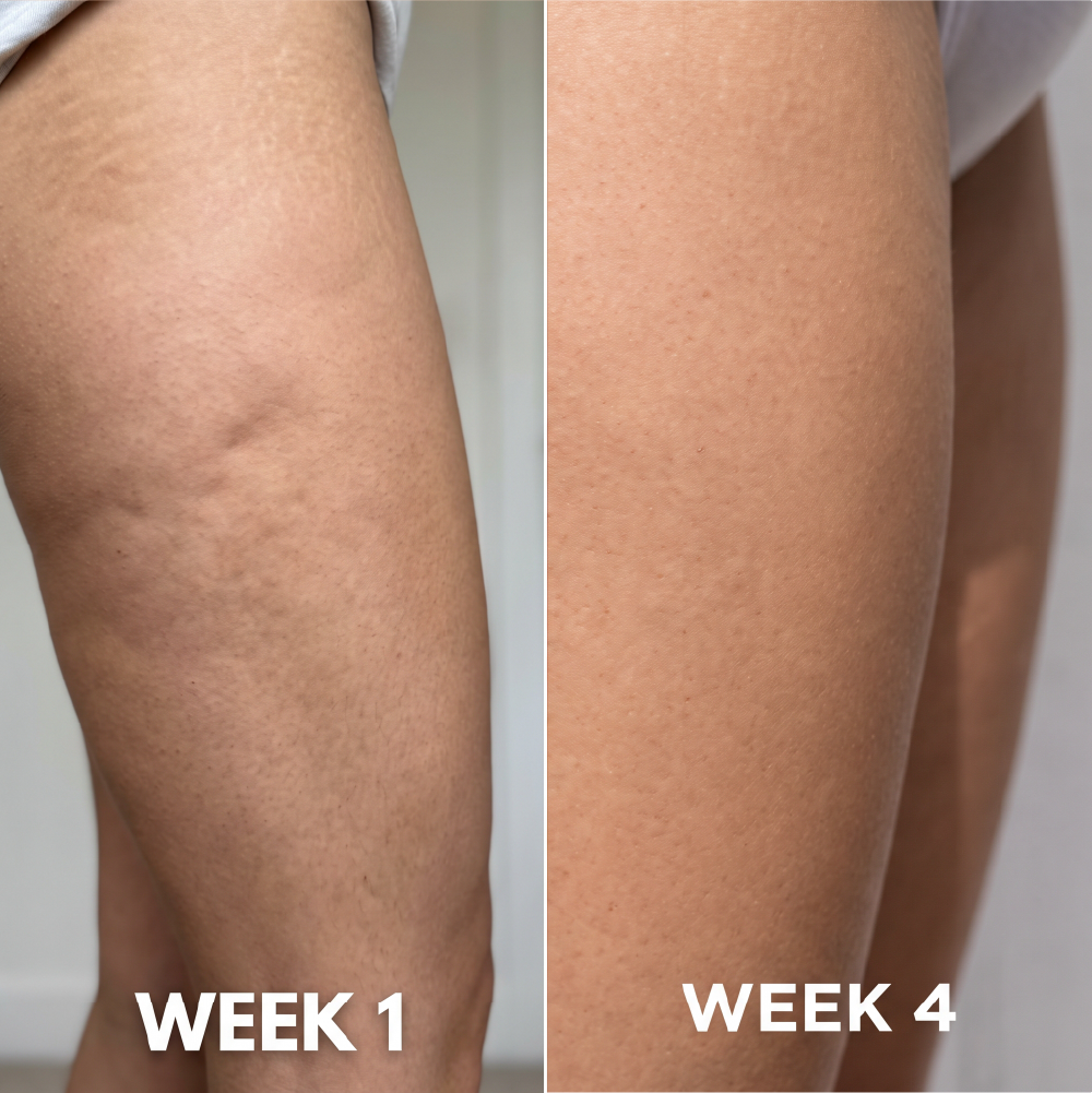 CelluClear™ Pro — Infrared Anti-Cellulite Vacuum Massager